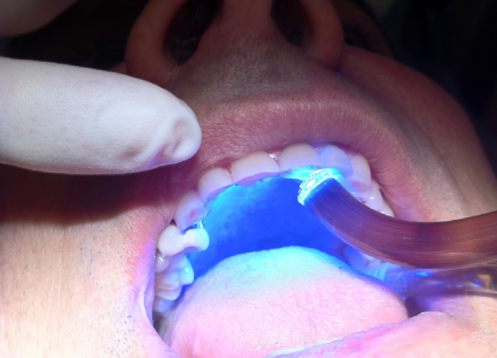 Terapia conservativa Studi dentistici Bazzoli e Bellini